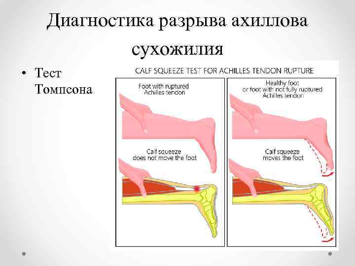 Симптом томпсона. Симптом Томпсона ахиллова сухожилия. Классификация разрывов ахиллова сухожилия. Повреждение ахиллова сухожилия тест Томпсона. Тест на разрыв ахиллова сухожилия.