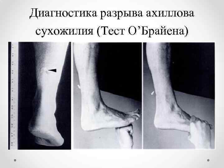 Диагностика разрыва ахиллова сухожилия (Тест О’Брайена) • Тест с иглой 