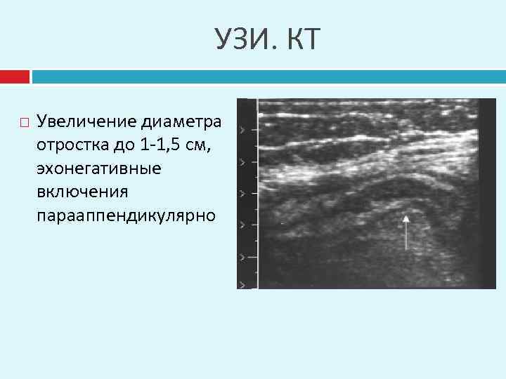 УЗИ. КТ Увеличение диаметра отростка до 1 -1, 5 см, эхонегативные включения парааппендикулярно 