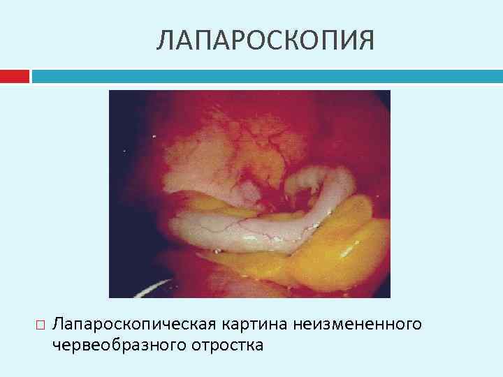 ЛАПАРОСКОПИЯ Лапароскопическая картина неизмененного червеобразного отростка 