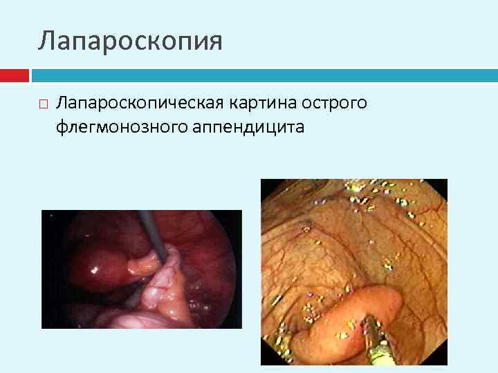 Лапароскопия Лапароскопическая картина острого флегмонозного аппендицита 