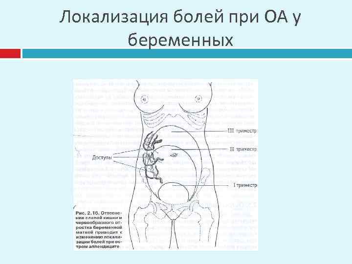 Локализация болей при ОА у беременных 