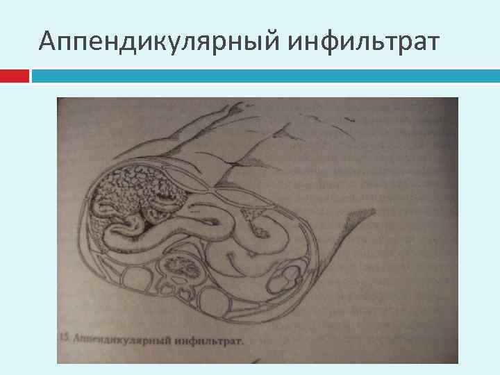 Аппендикулярный инфильтрат 