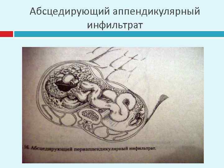 Абсцедирующий аппендикулярный инфильтрат 