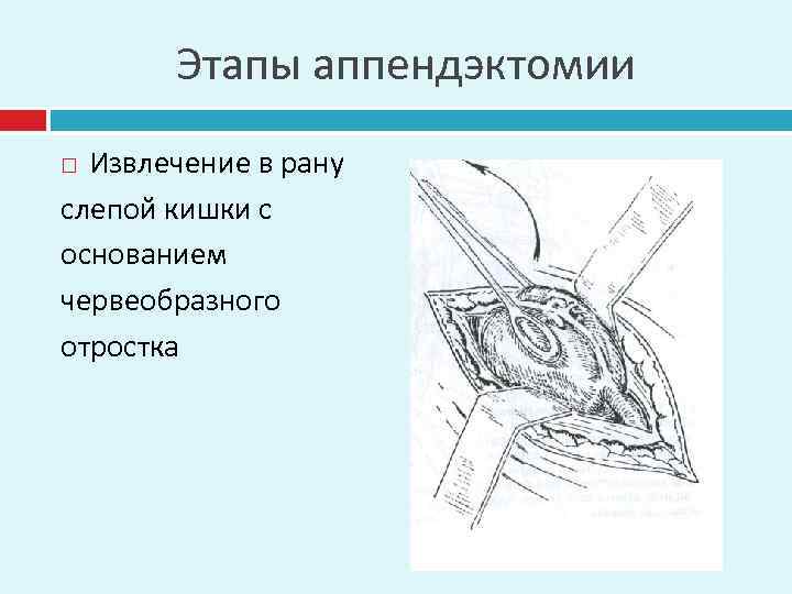 Этапы аппендэктомии Извлечение в рану слепой кишки с основанием червеобразного отростка 