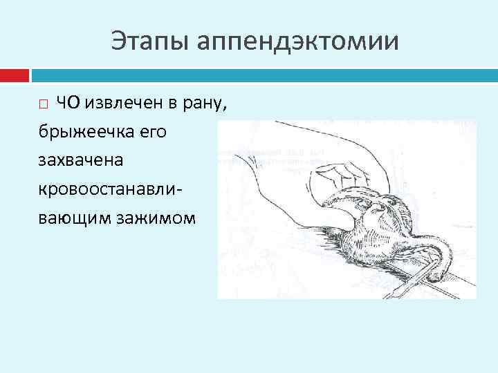 Этапы аппендэктомии ЧО извлечен в рану, брыжеечка его захвачена кровоостанавливающим зажимом 