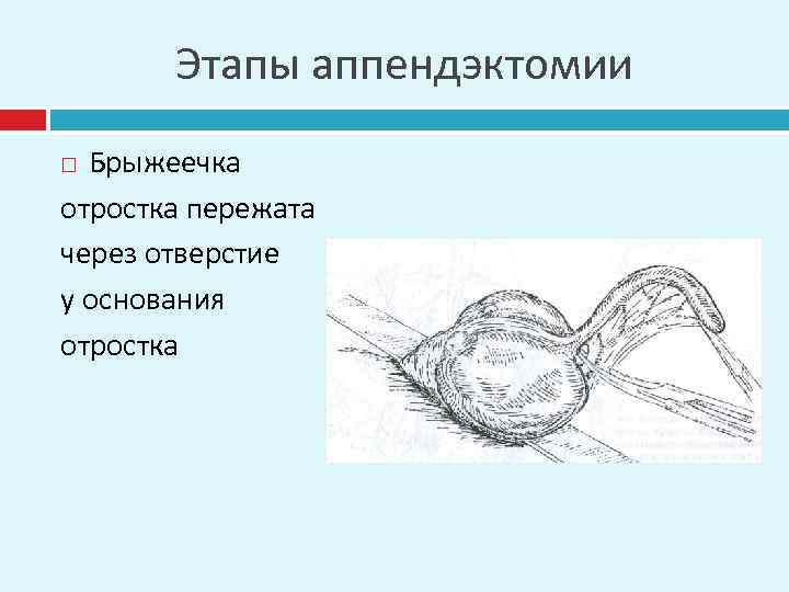 Этапы аппендэктомии Брыжеечка отростка пережата через отверстие у основания отростка 