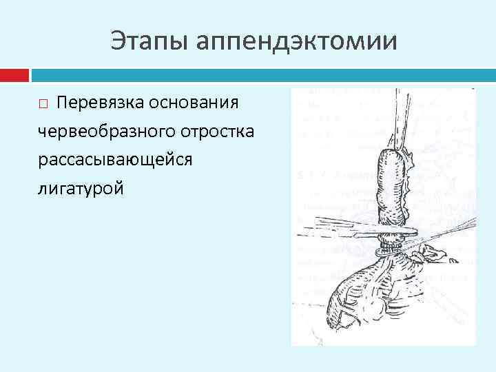 Этапы аппендэктомии Перевязка основания червеобразного отростка рассасывающейся лигатурой 