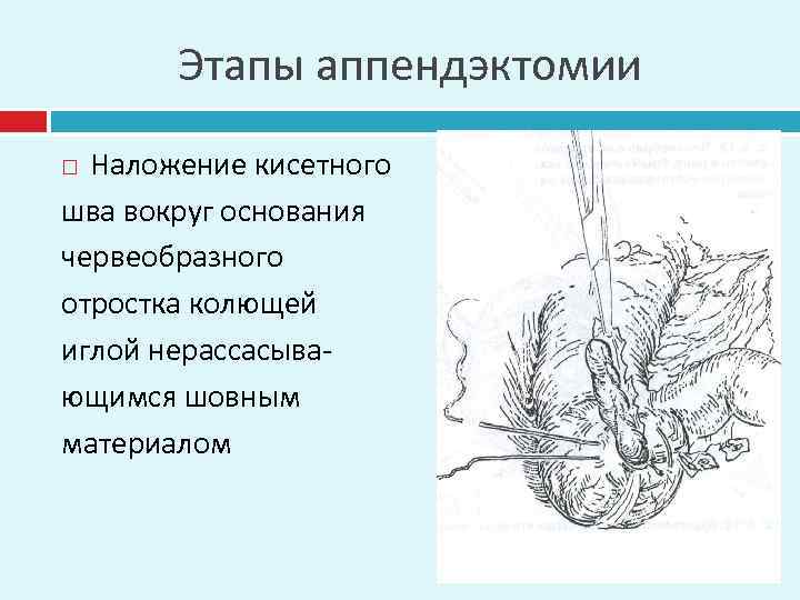 Этапы аппендэктомии Наложение кисетного шва вокруг основания червеобразного отростка колющей иглой нерассасывающимся шовным материалом