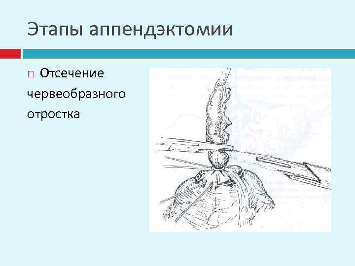 Этапы аппендэктомии Отсечение червеобразного отростка 