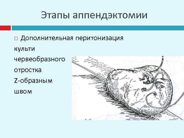 Этапы аппендэктомии Дополнительная перитонизация культи червеобразного отростка Z-образным швом 