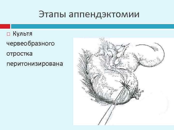 Этапы аппендэктомии Культя червеобразного отростка перитонизирована 