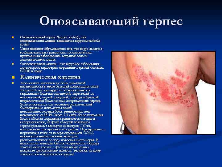 Опоясывающий герпес n n n Опоясывающий герпес (herpes zoster) , или (herpes zoster) опоясывающий