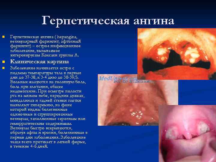 Герпетическая ангина n Герпетическая ангина ( hepangina, везикулярный фарингит, афтозный фарингит) – острое инфекционное