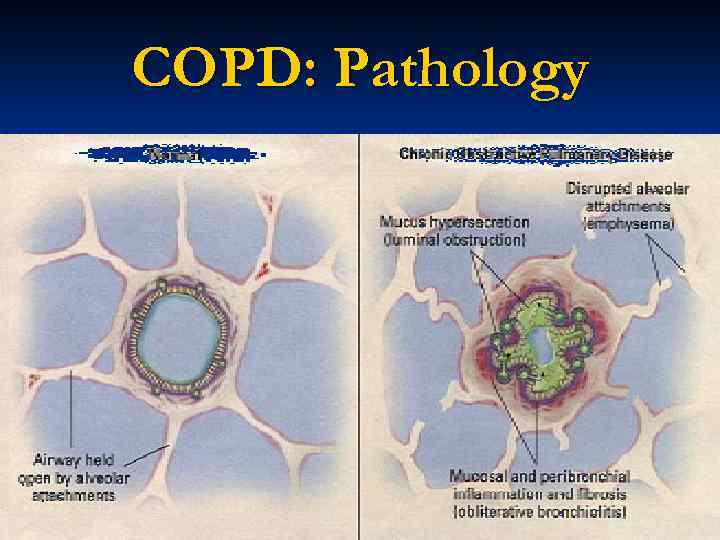 COPD: Pathology 