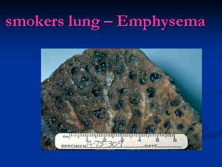 smokers lung – Emphysema 