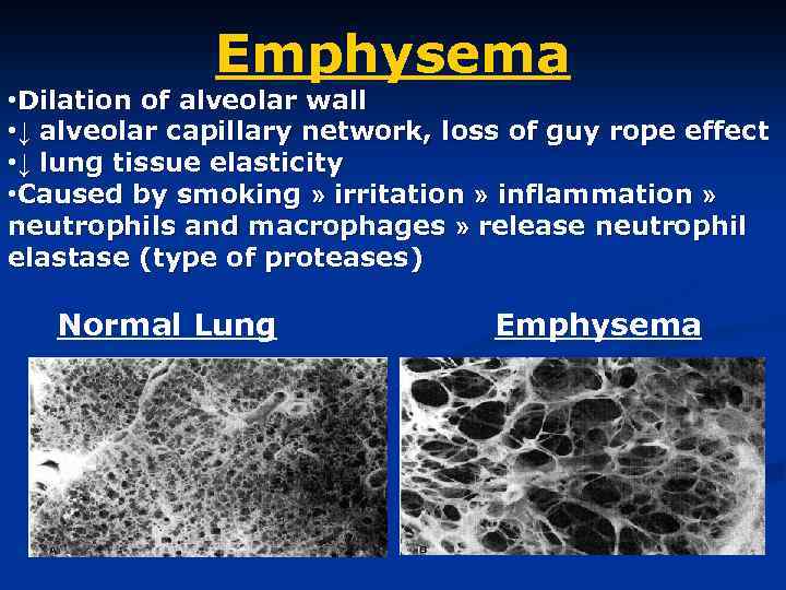 Emphysema • Dilation of alveolar wall • ↓ alveolar capillary network, loss of guy