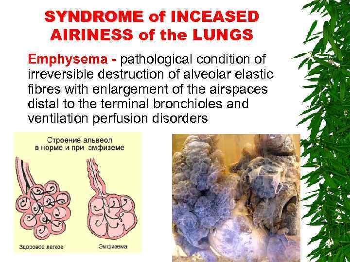 SYNDROME of INCEASED AIRINESS of the LUNGS Emphysema - pathological condition of irreversible destruction