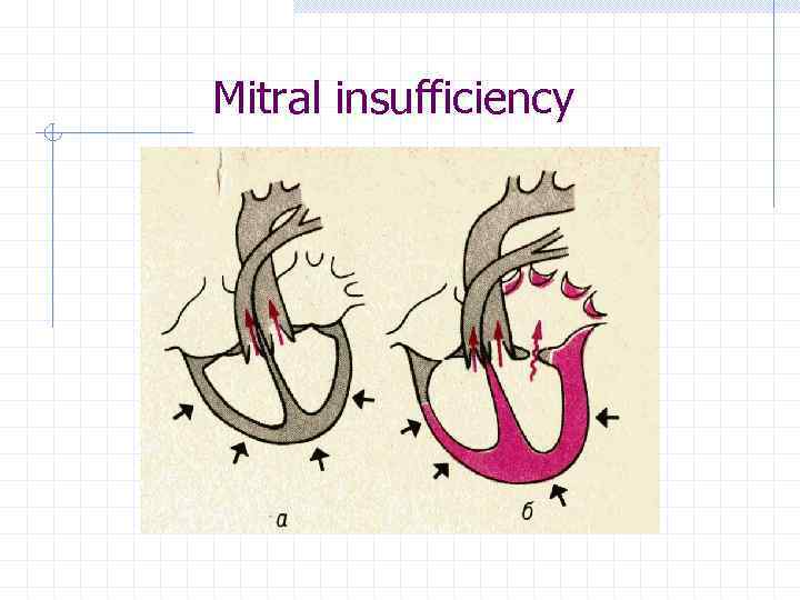 Mitral insufficiency 