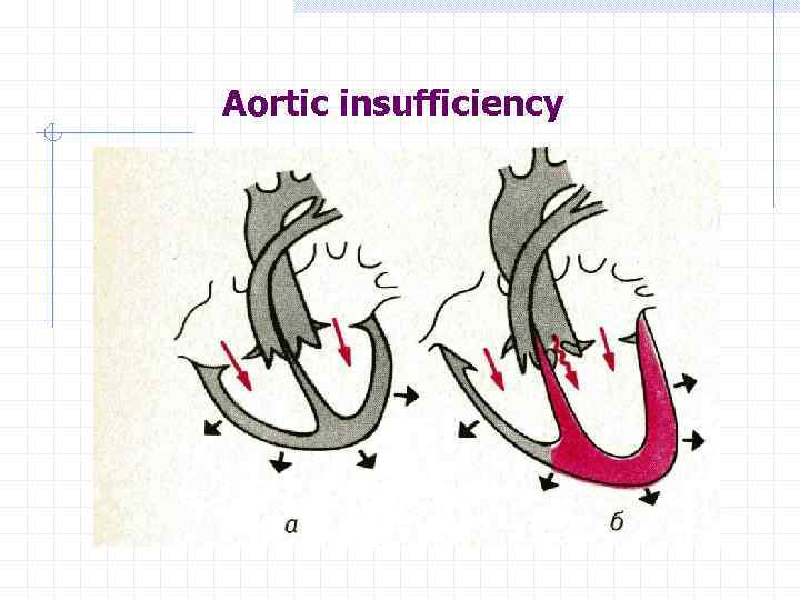 Aortic insufficiency 