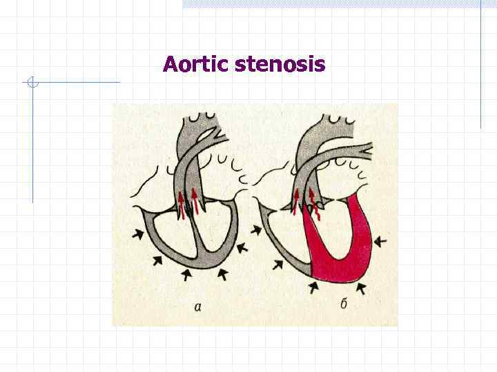 Aortic stenosis 