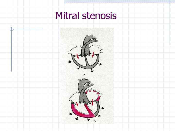 Mitral stenosis 