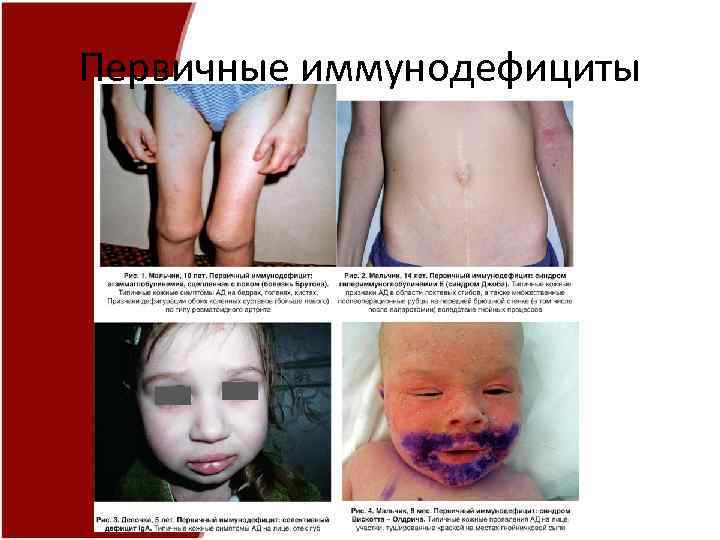 Первичные иммунодефициты 