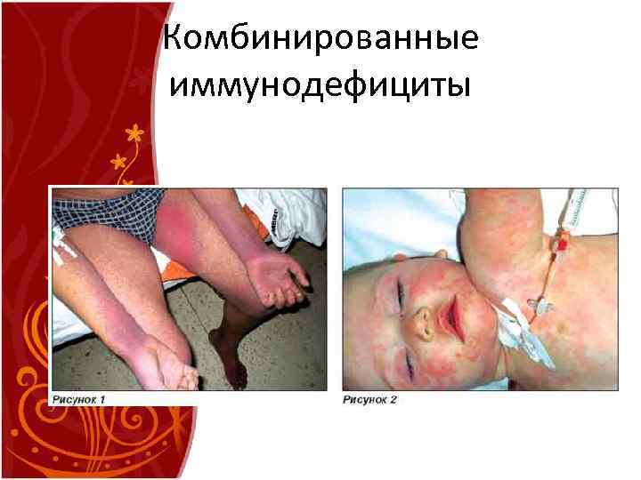 Комбинированные иммунодефициты 