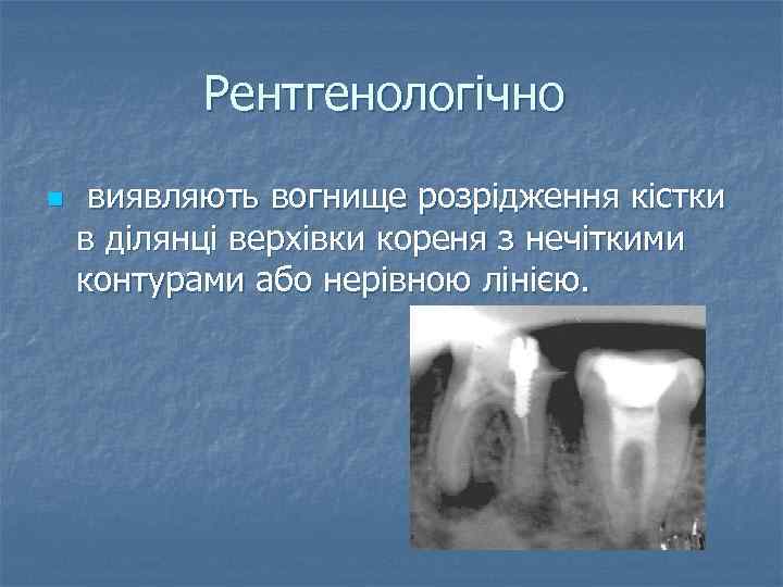 Рентгенологічно n виявляють вогнище розрідження кістки в ділянці верхівки кореня з нечіткими контурами або
