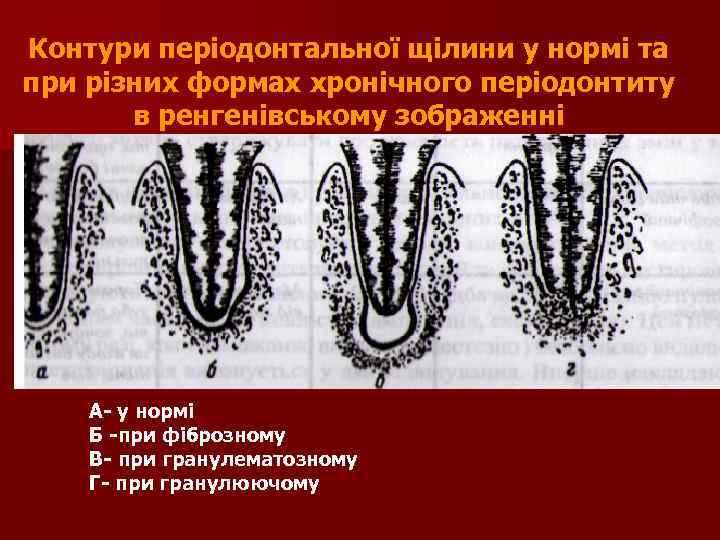 Контури періодонтальної щілини у нормі та при різних формах хронічного періодонтиту в ренгенівському зображенні