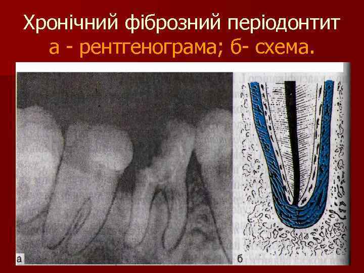 Хронічний фіброзний періодонтит а - рентгенограма; б- схема. 