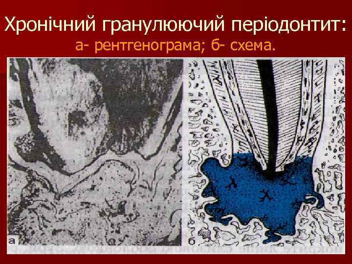 Хронічний гранулюючий періодонтит: а- рентгенограма; б- схема. 