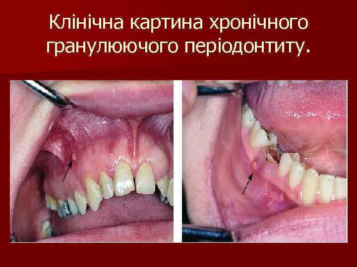 Клінічна картина хронічного гранулюючого періодонтиту. 