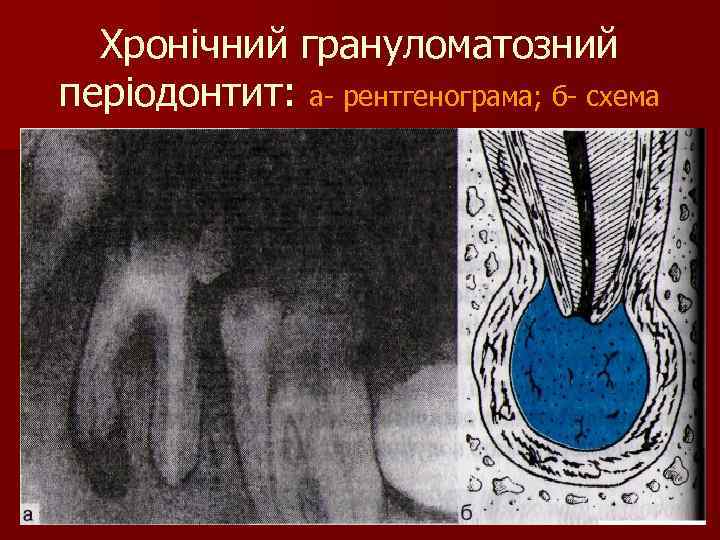 Хронічний грануломатозний періодонтит: а- рентгенограма; б- схема 