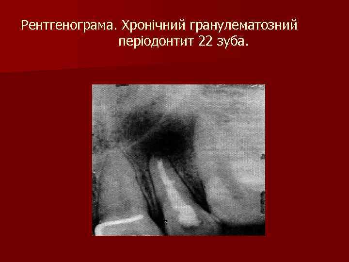 Рентгенограма. Хронічний гранулематозний періодонтит 22 зуба. 