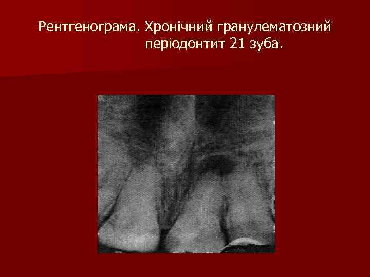 Рентгенограма. Хронічний гранулематозний періодонтит 21 зуба. 