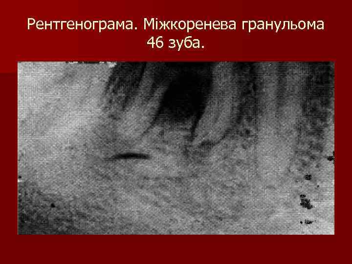 Рентгенограма. Міжкоренева гранульома 46 зуба. 