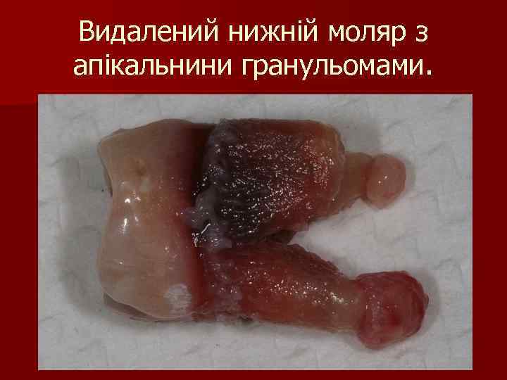 Видалений нижній моляр з апікальнини гранульомами. 