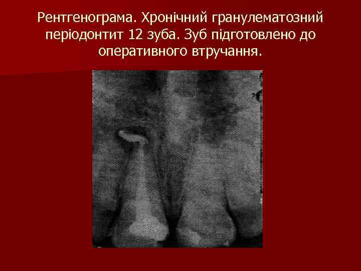 Рентгенограма. Хронічний гранулематозний періодонтит 12 зуба. Зуб підготовлено до оперативного втручання. 