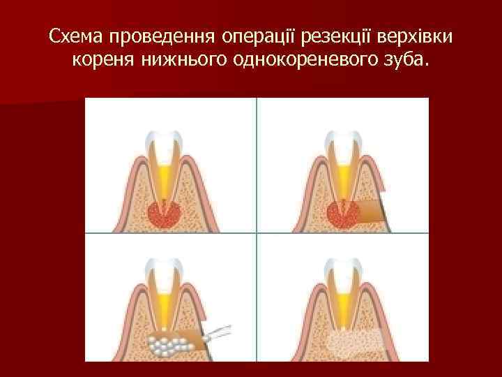 Схема проведення операції резекції верхівки кореня нижнього однокореневого зуба. 