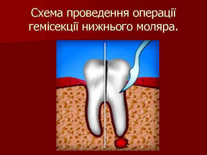 Схема проведення операції гемісекції нижнього моляра. 