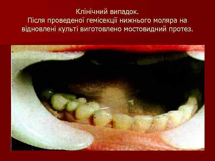 Клінічний випадок. Після проведеної гемісекції нижнього моляра на відновлені культі виготовлено мостовидний протез. 