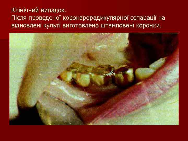 Клінічний випадок. Після проведеної коронарорадикулярної сепарації на відновлені культі виготовлено штамповані коронки. 