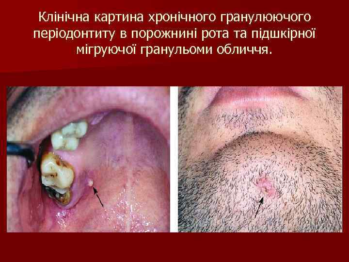 Клінічна картина хронічного гранулюючого періодонтиту в порожнині рота та підшкірної мігруючої гранульоми обличчя. 