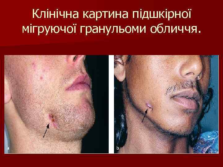 Клінічна картина підшкірної мігруючої гранульоми обличчя. 