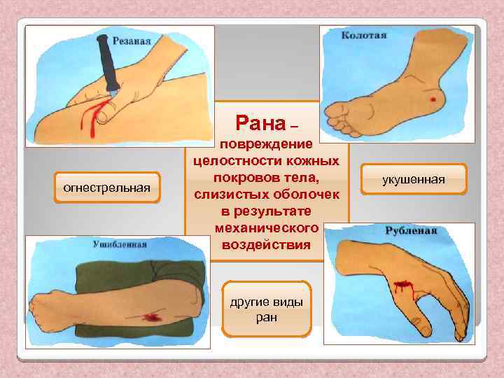 Рана – огнестрельная повреждение целостности кожных покровов тела, слизистых оболочек в результате механического воздействия