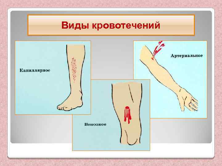 Виды кровотечений 