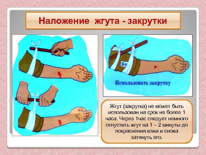Наложение жгута - закрутки Жгут (закрутка) не может быть использован на срок не более