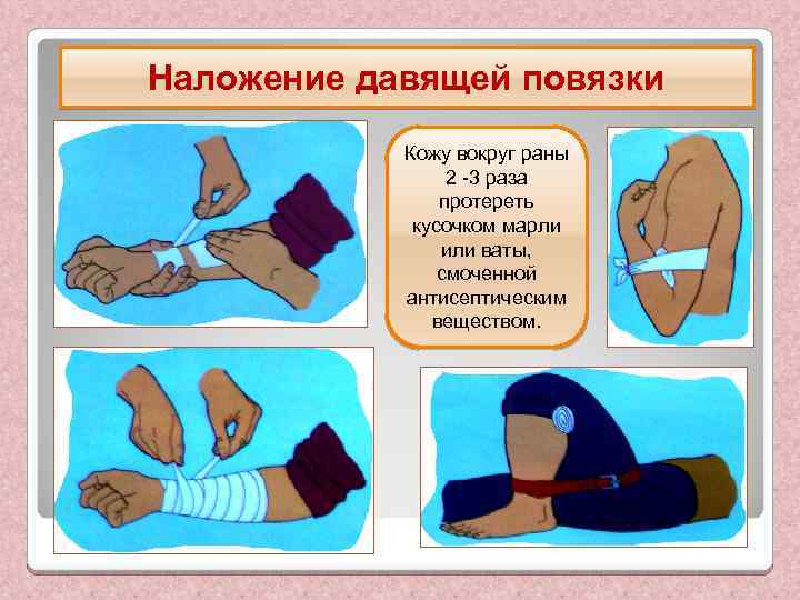 Наложение давящей повязки Кожу вокруг раны 2 -3 раза протереть кусочком марли или ваты,