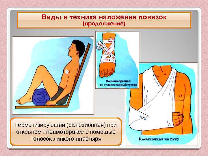 Виды и техника наложения повязок (продолжение) Герметизирующая (оклюзионная) при открытом пневмотораксе с помощью полосок
